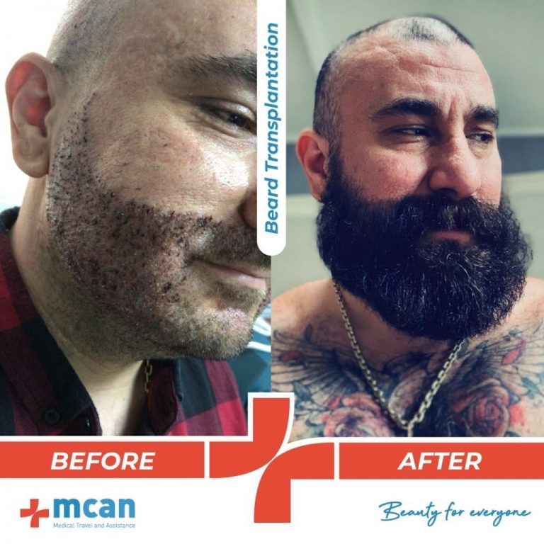 Before & After Beard MCAN Health