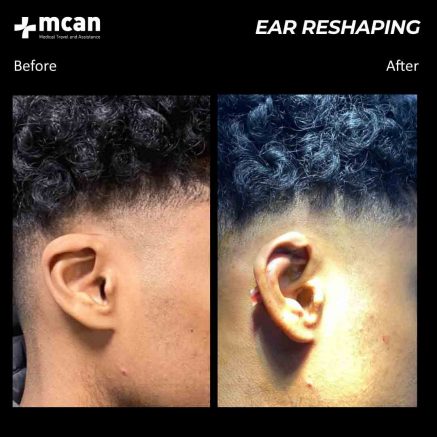 ear reshaping turkey before after 01