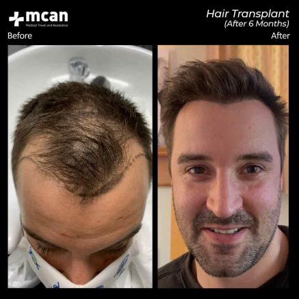 hair transplant turkey mcan health