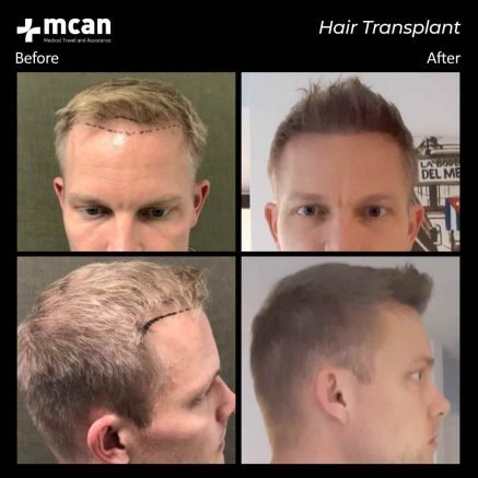 hair transplant turkey mcan health 02 1