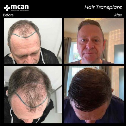 hair transplant turkey mcan health 03 1