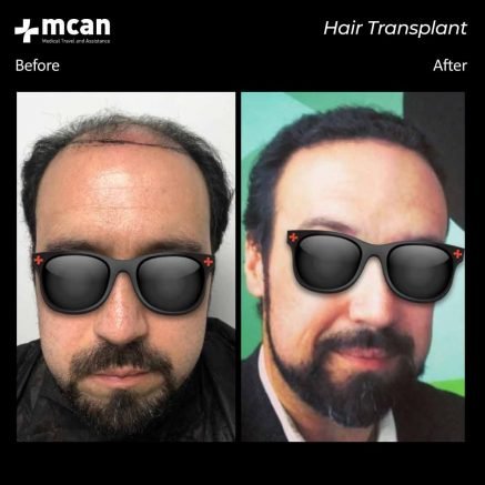 hair transplant turkey mcan health 04 1