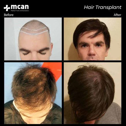 hair transplant turkey mcan health