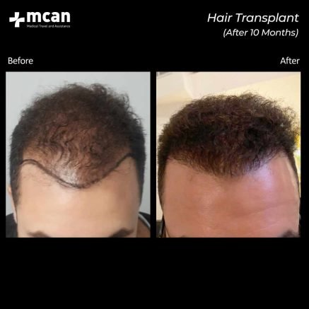 hair transplant turkey mcan health 07 1