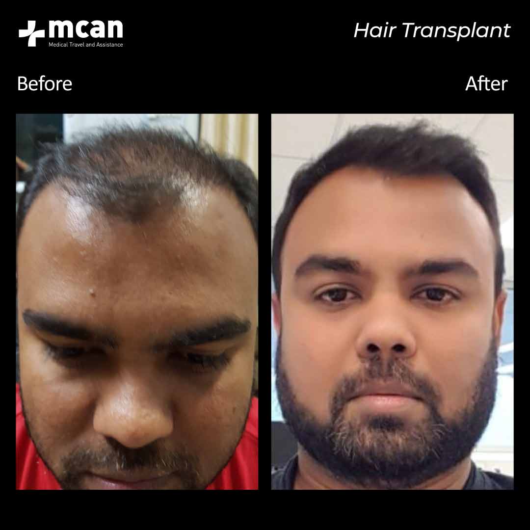 hair transplantation 100