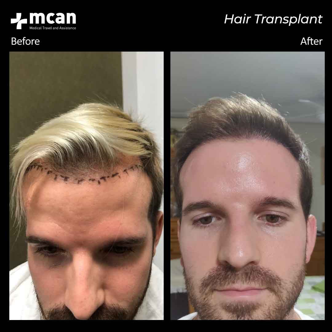 hair transplantation 102