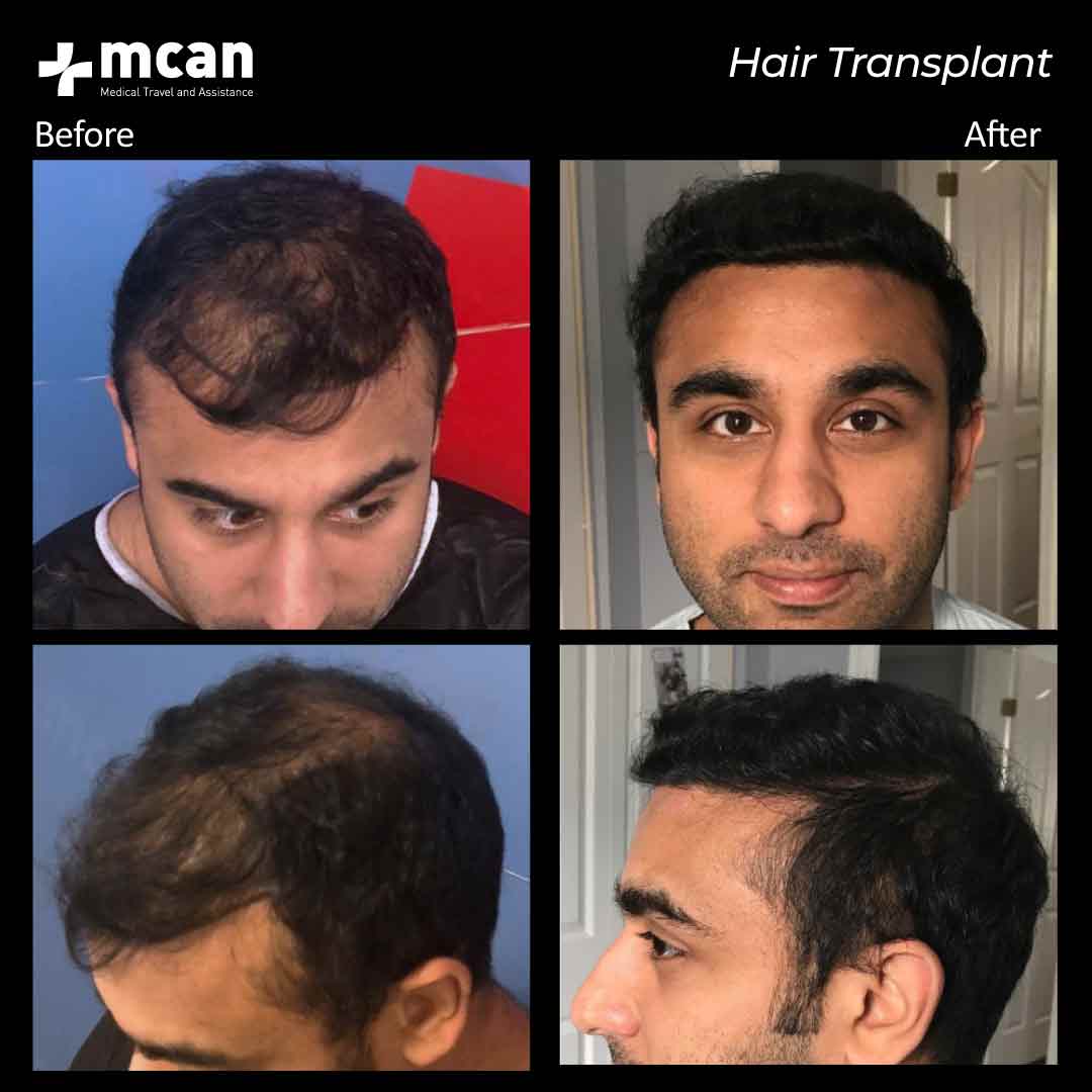 hair transplantation 103