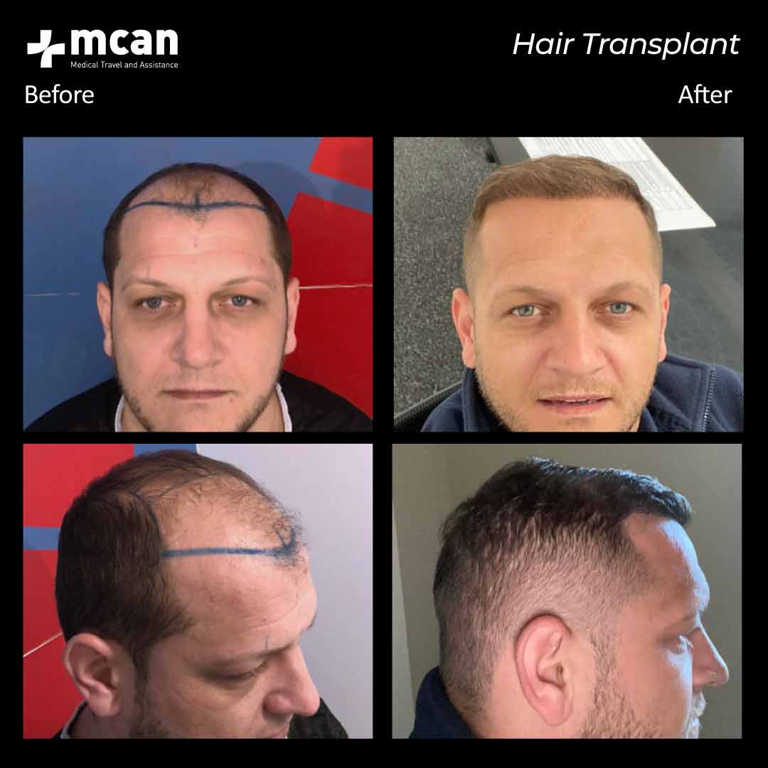 hair transplantation 105