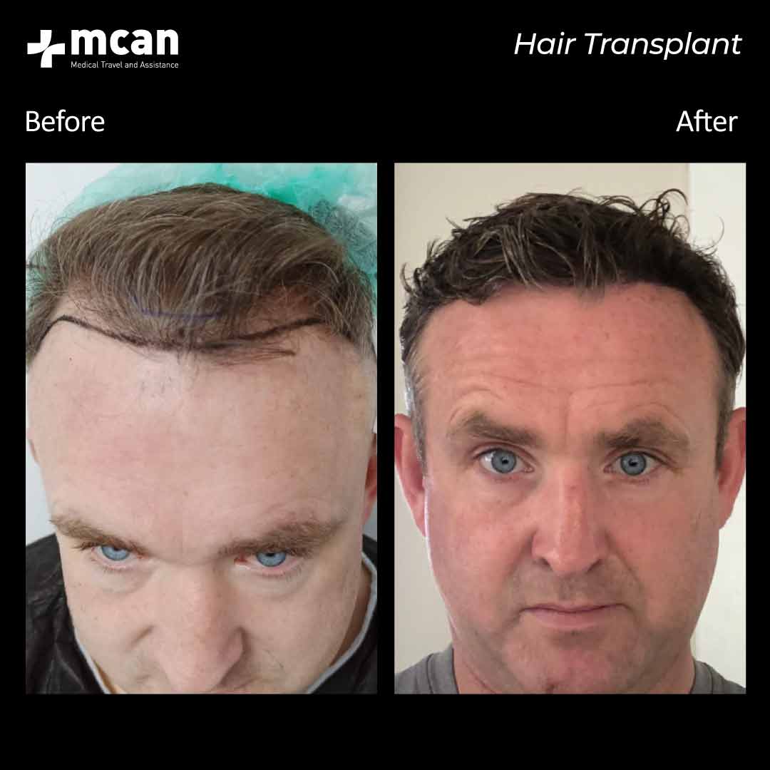 hair transplantation 109