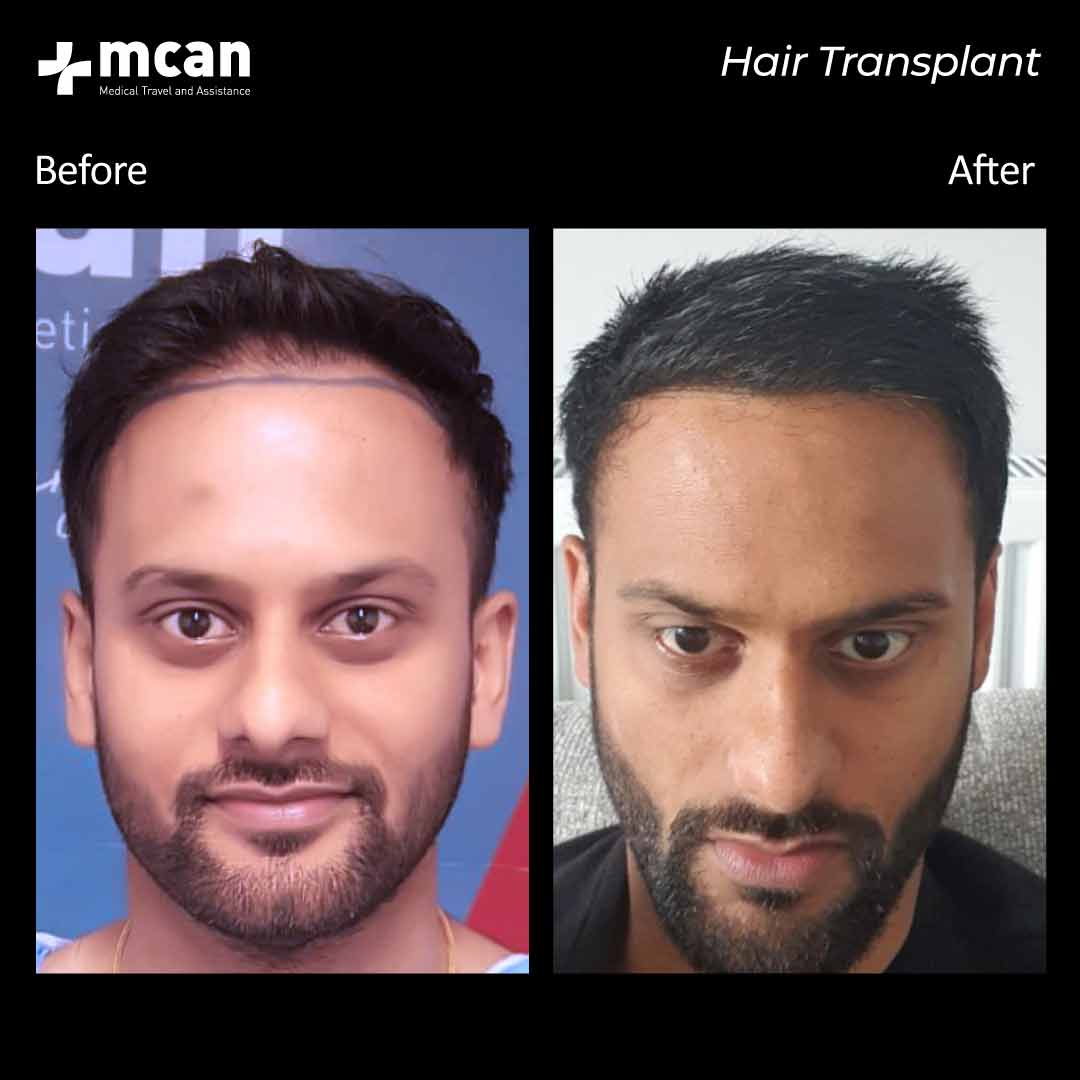 hair transplantation 110