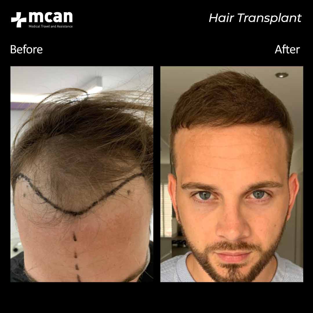hair transplantation 111