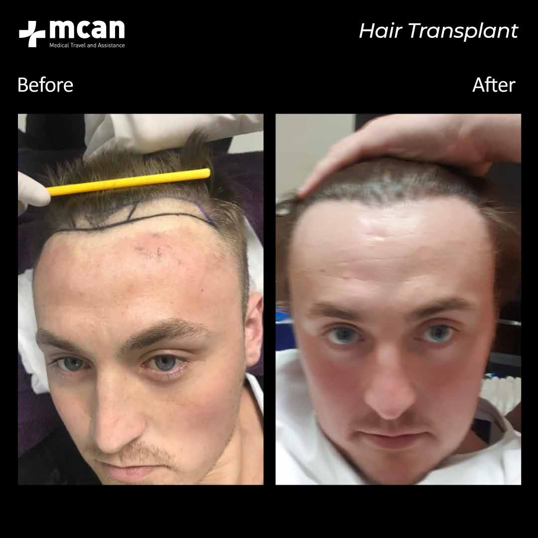 hair transplantation 112