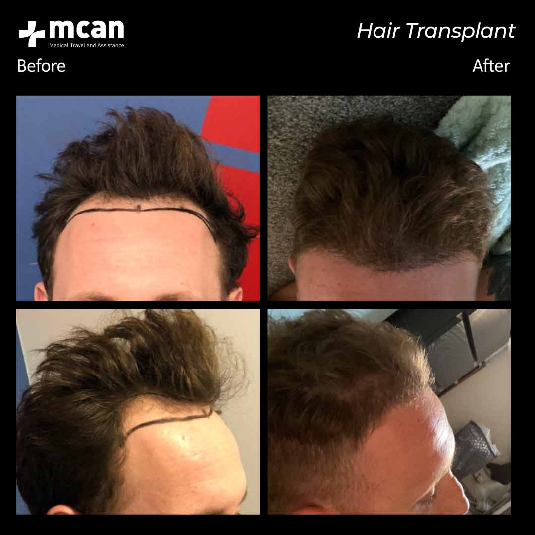 hair transplantation 113