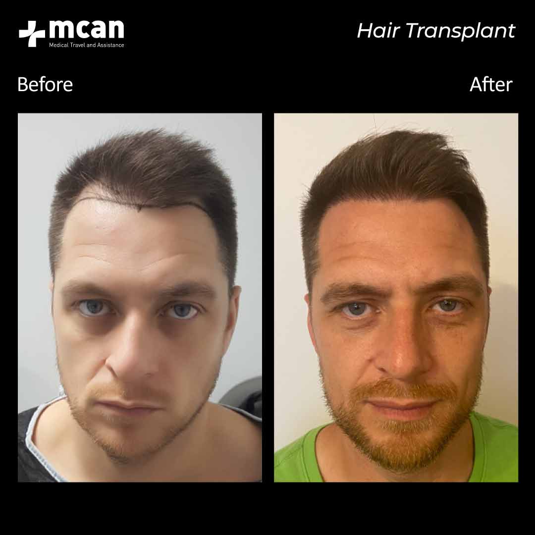 hair transplantation 114