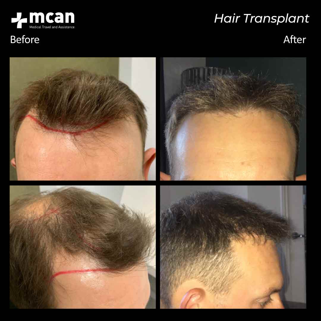 hair transplantation 115