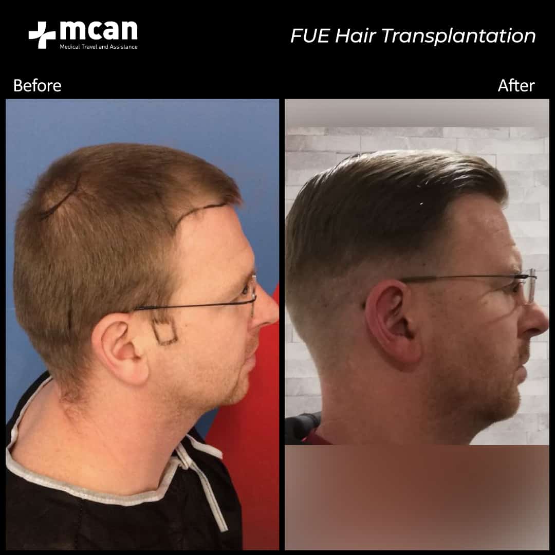 hair transplantation 32