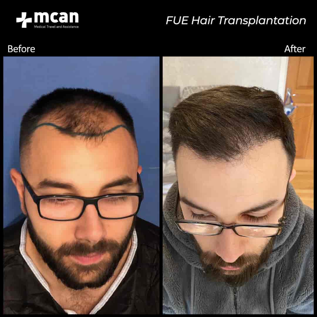 Hair Transplantation Before and After - MCAN Health