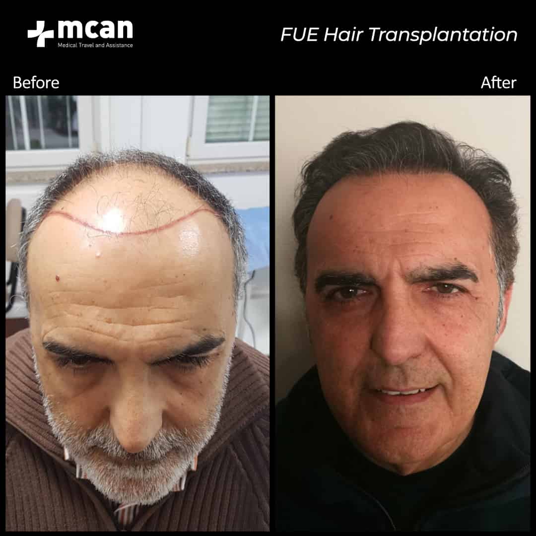 hair transplantation 34