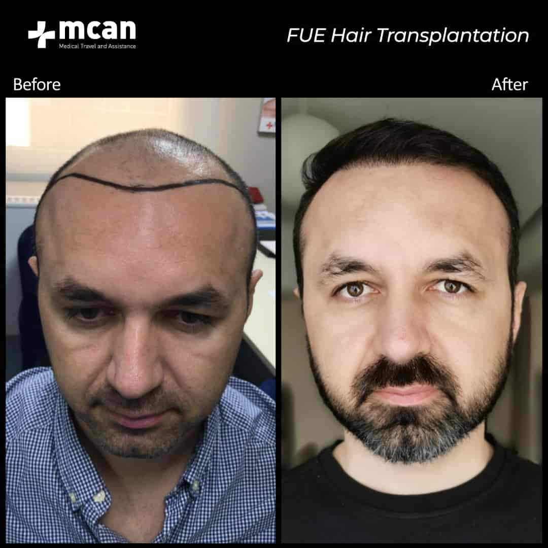 hair transplantation 36