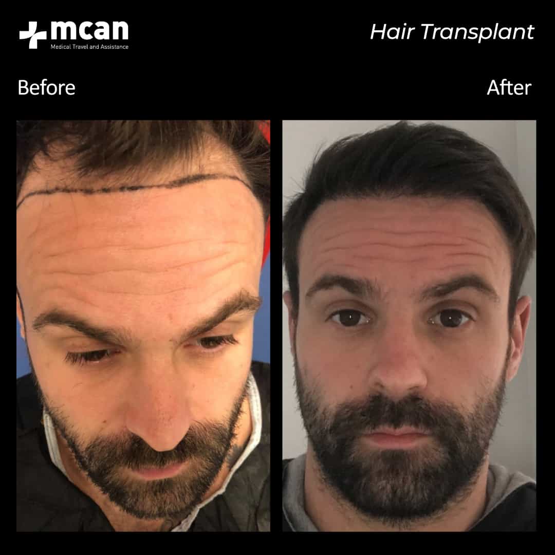 hair transplantation 50