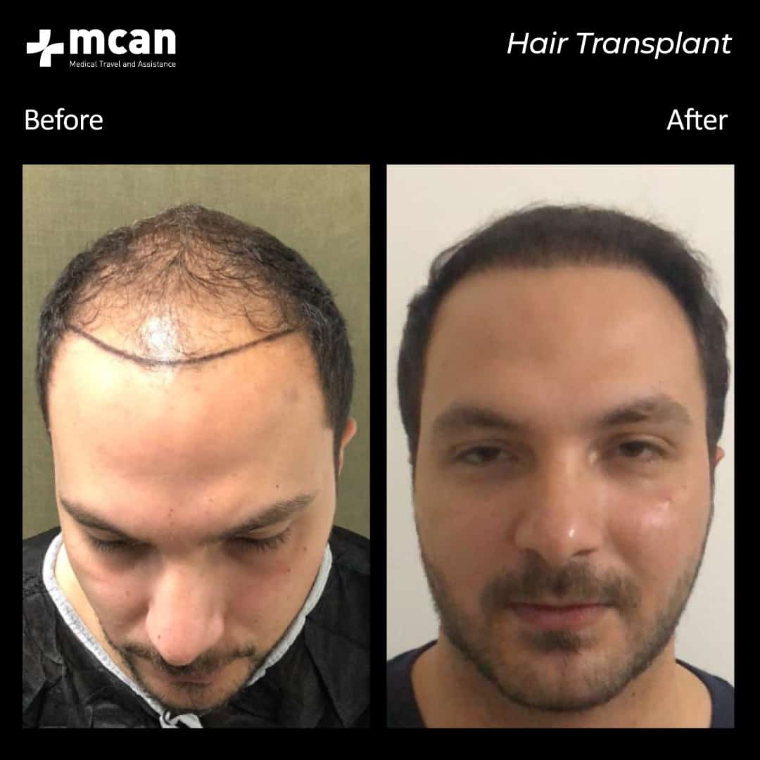 hair transplantation 53