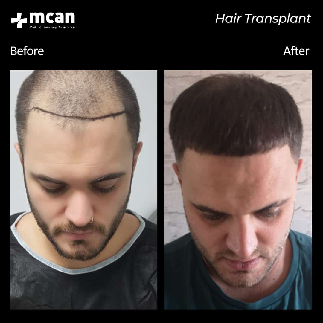 hair transplantation 54