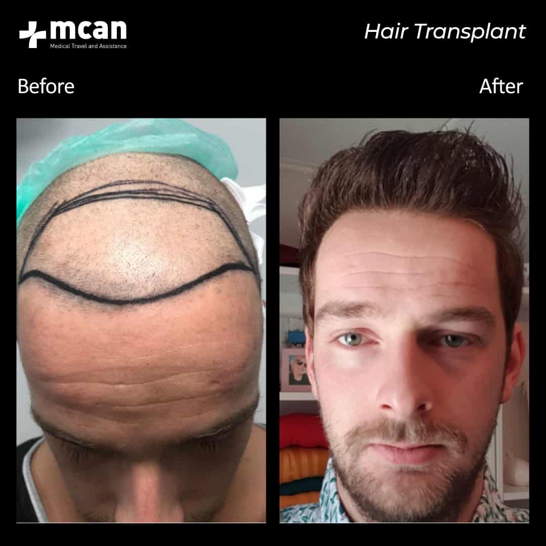hair transplantation 55