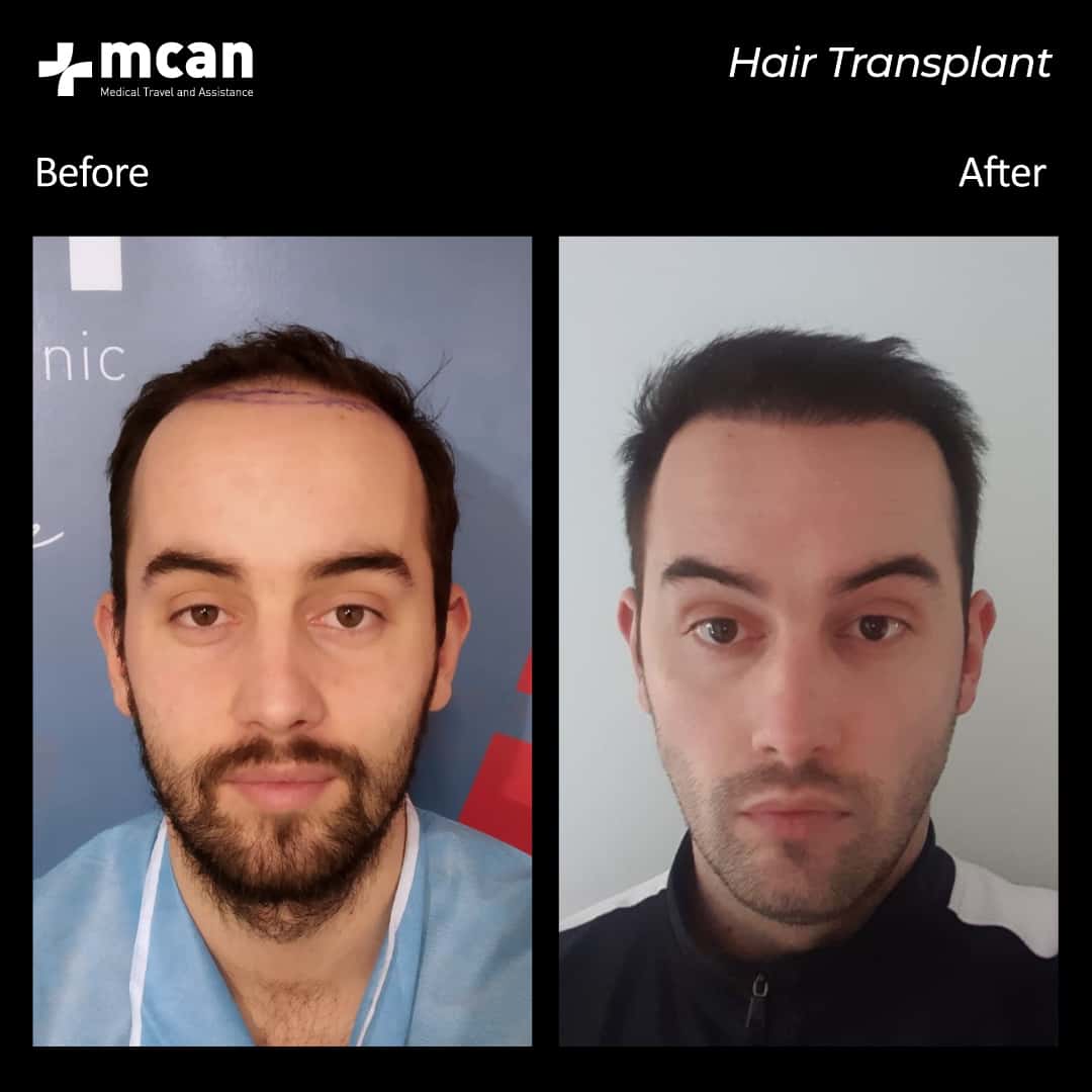 hair transplantation 57