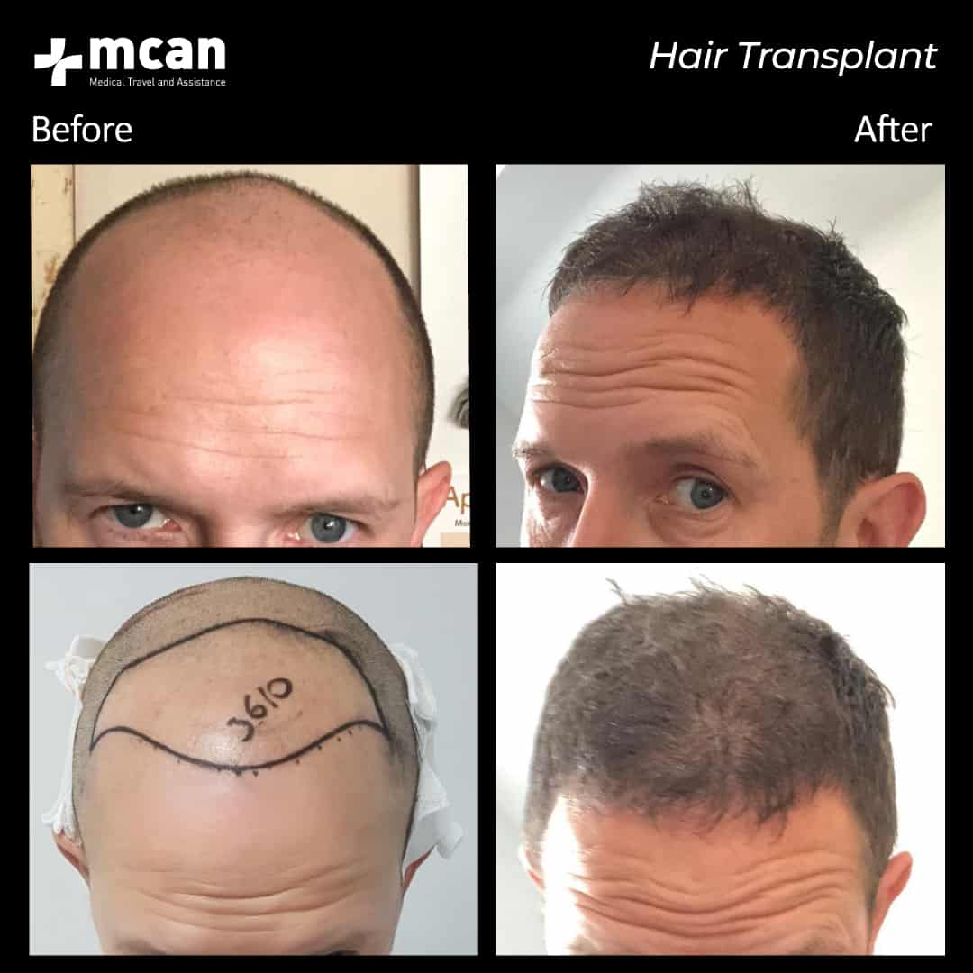 hair transplantation 60