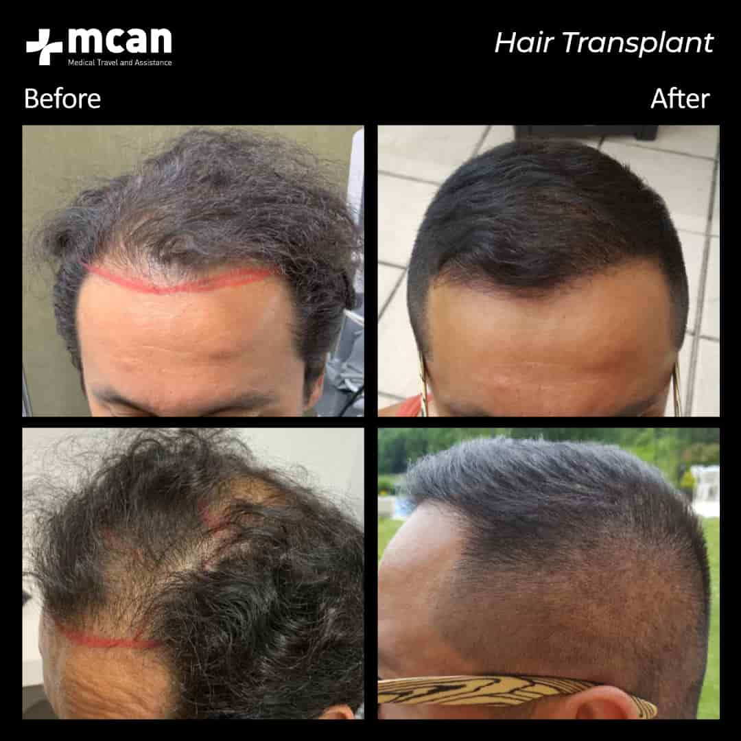 hair transplantation 64