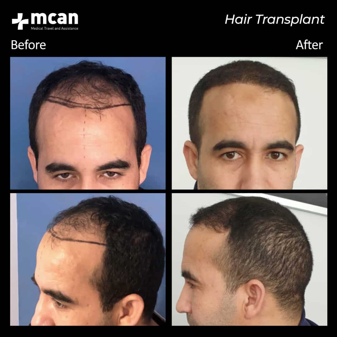 hair transplantation 66