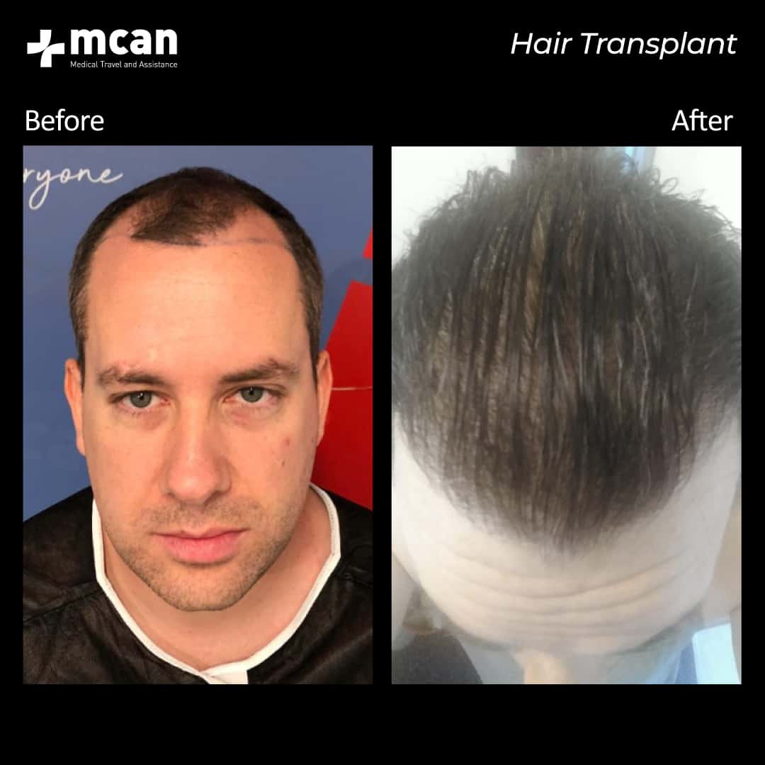 hair transplantation 68