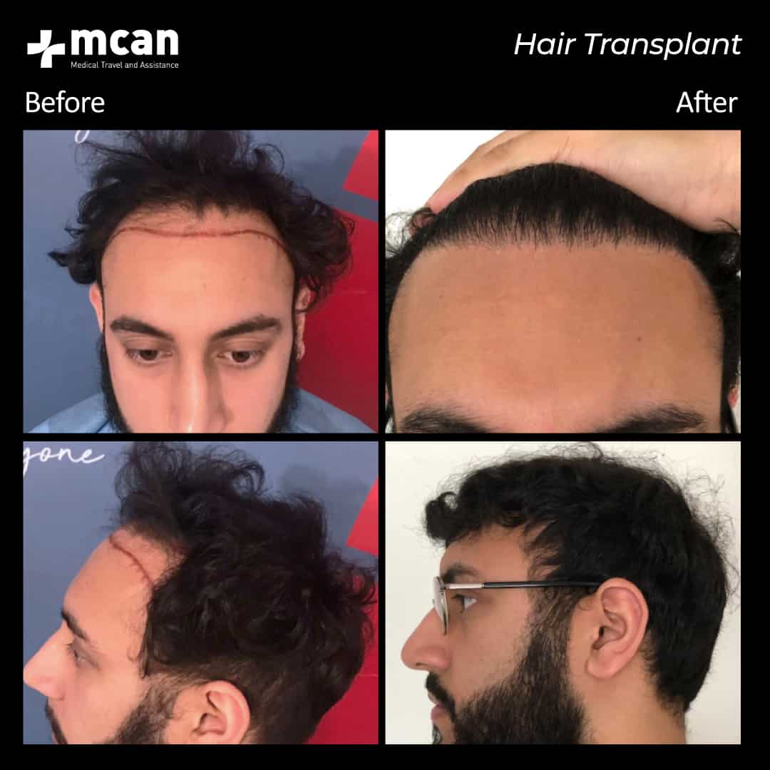hair transplantation 70