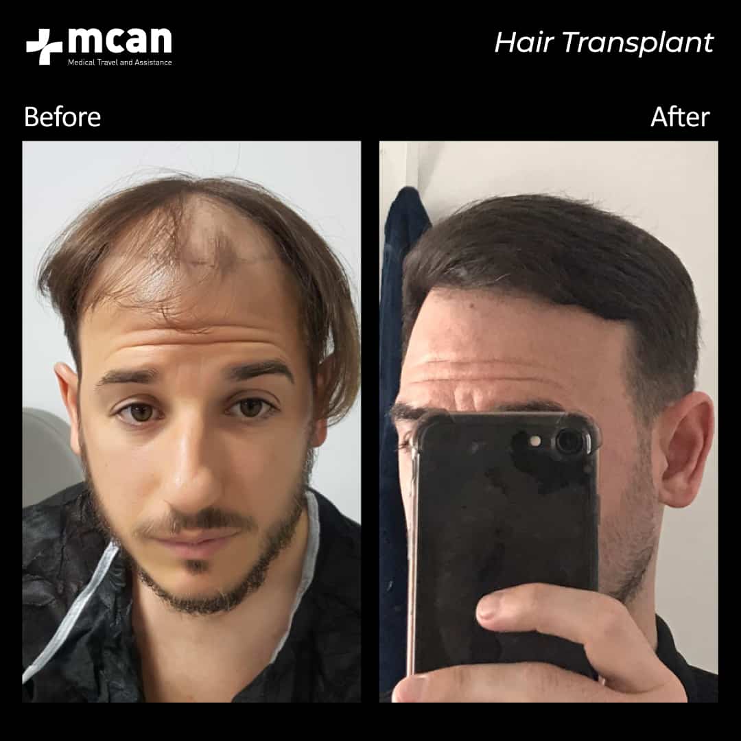 hair transplantation 71