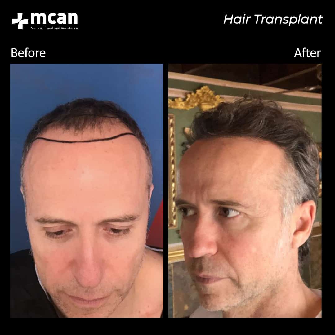hair transplantation 73