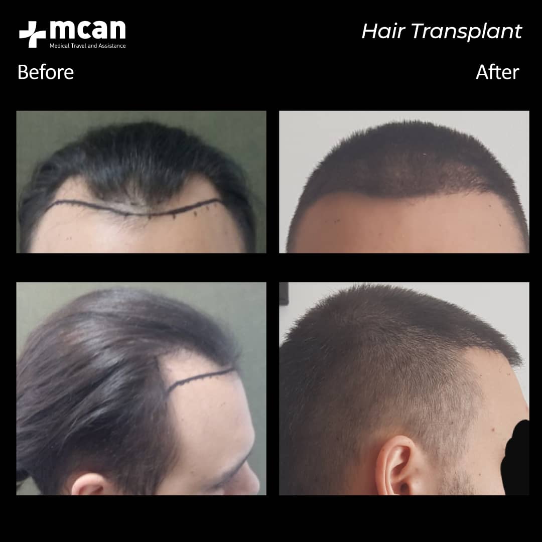 hair transplantation 74