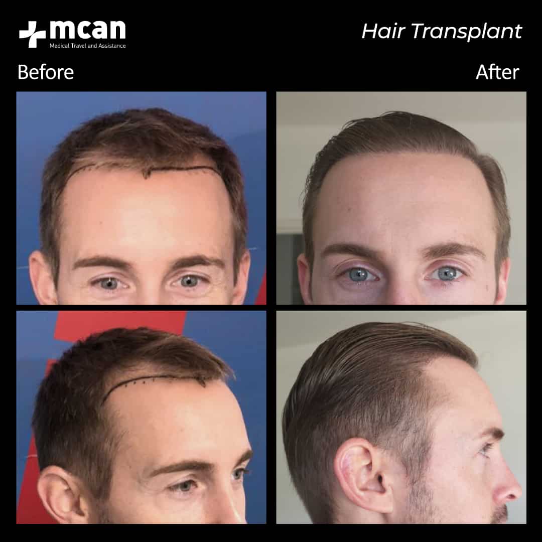 hair transplantation 75