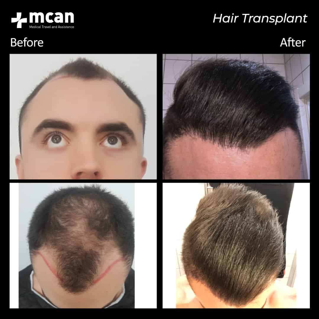 hair transplantation 76