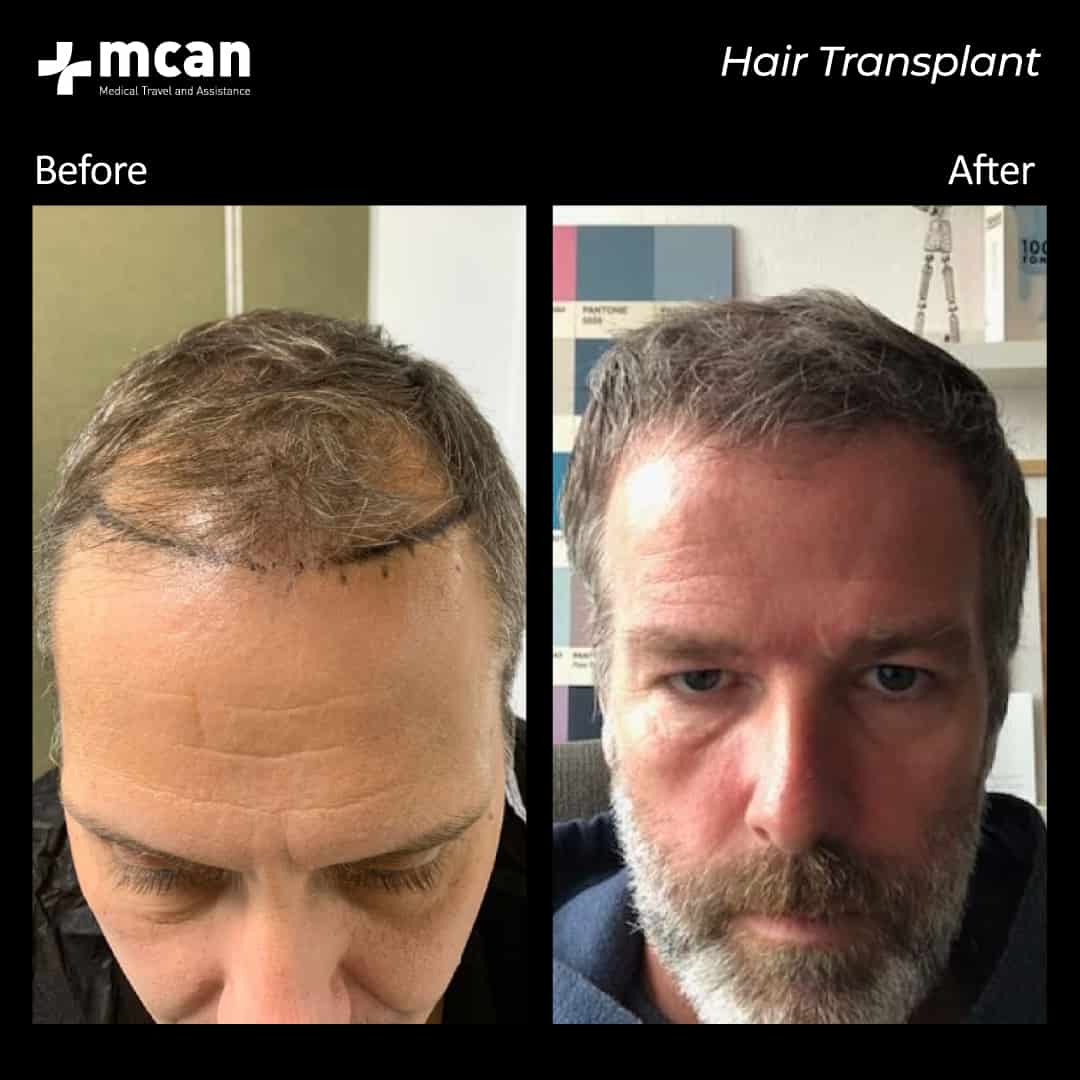 hair transplantation 77