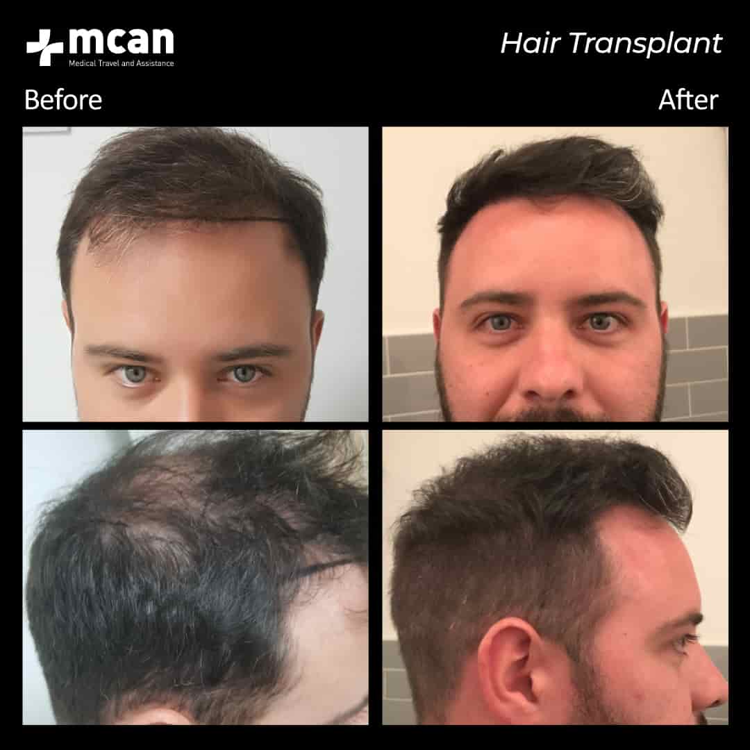 hair transplantation 81