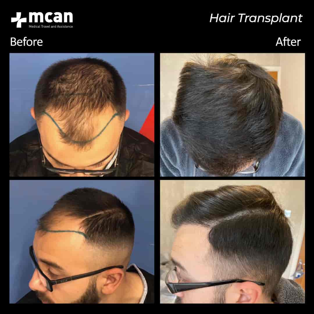 hair transplantation 83
