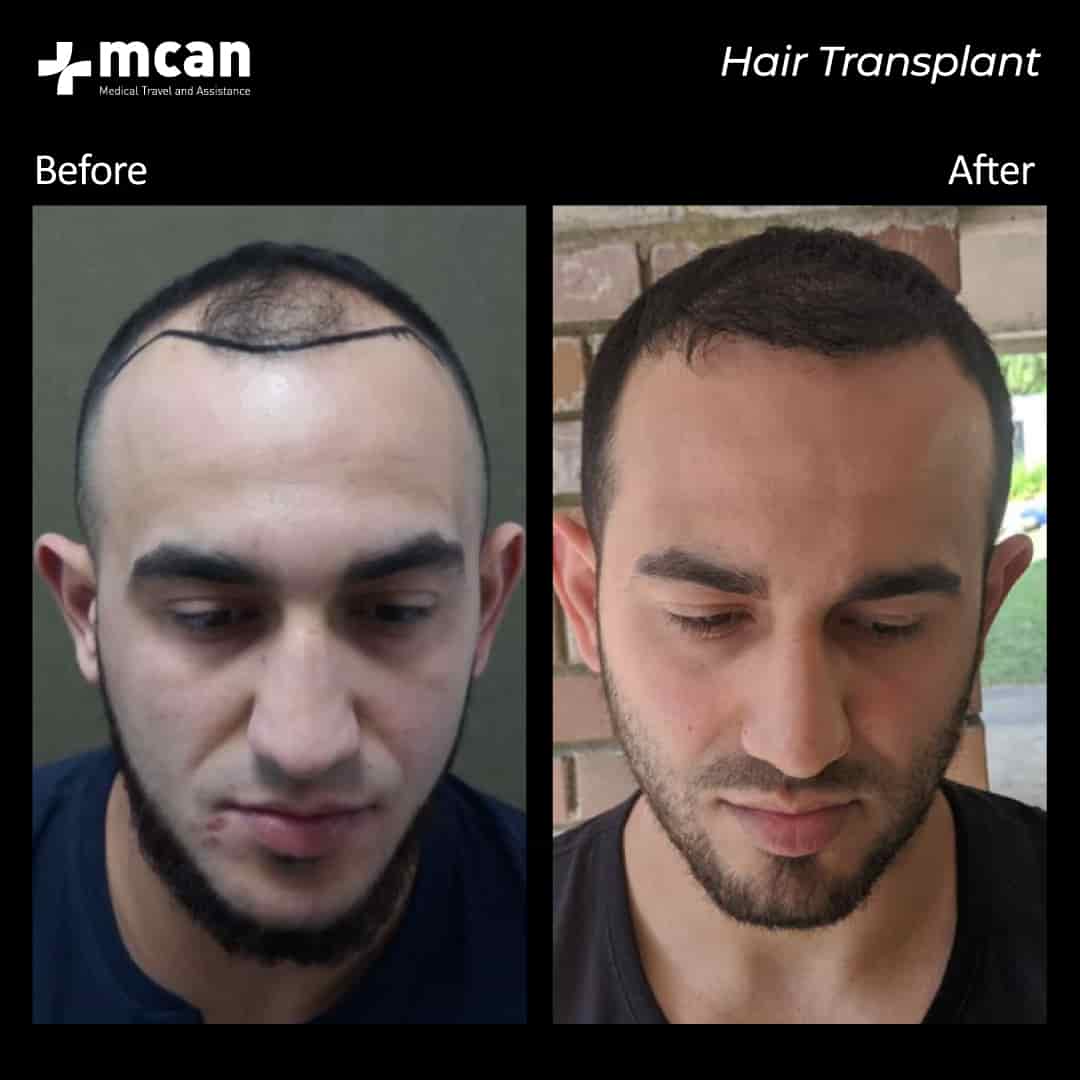hair transplantation 84