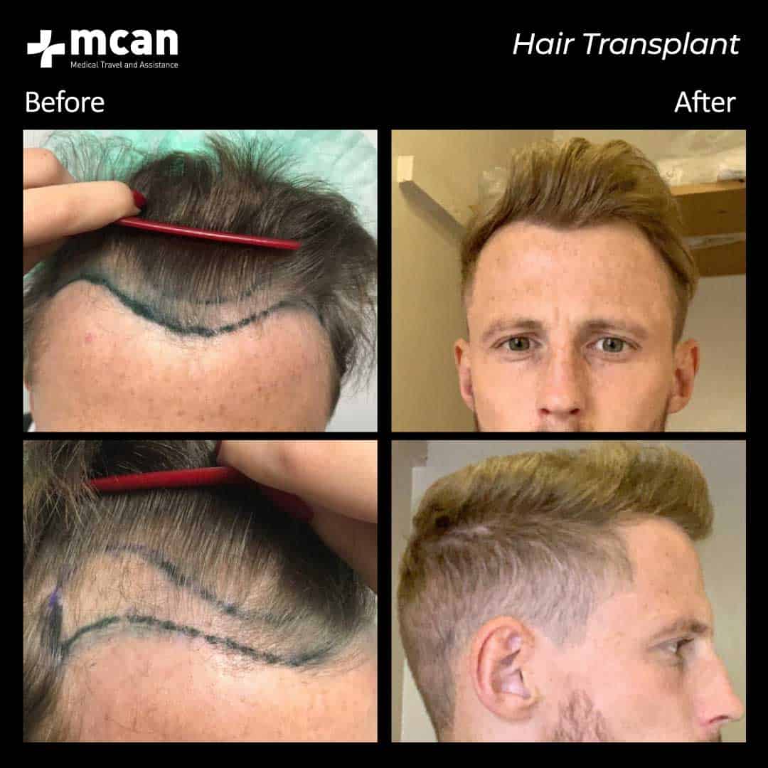 hair transplantation 87