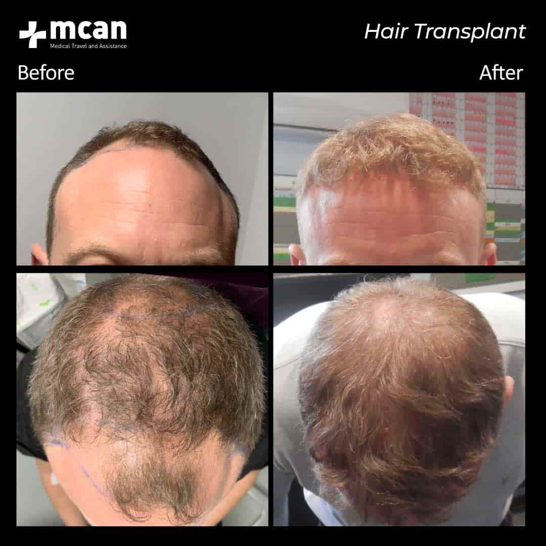 hair transplantation 89