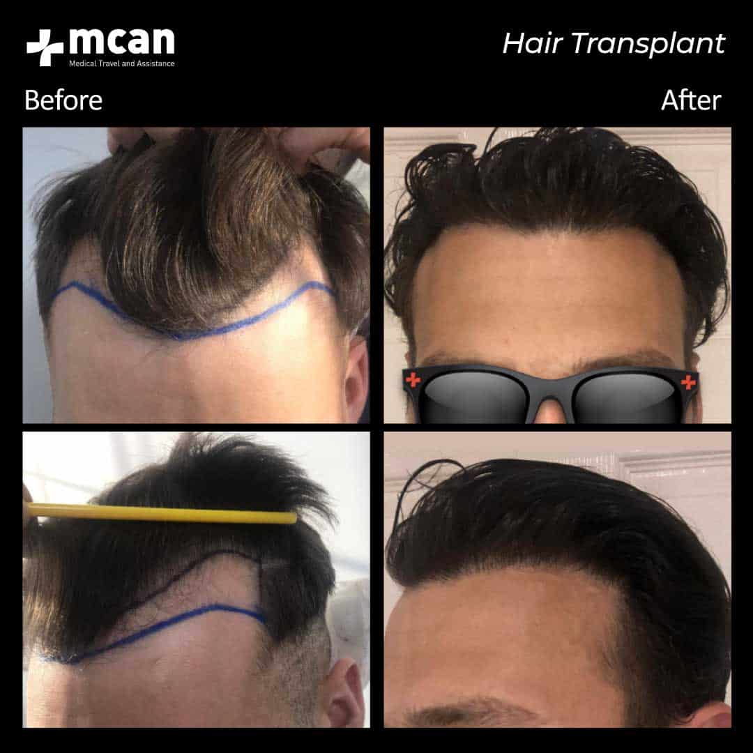 hair transplantation 90