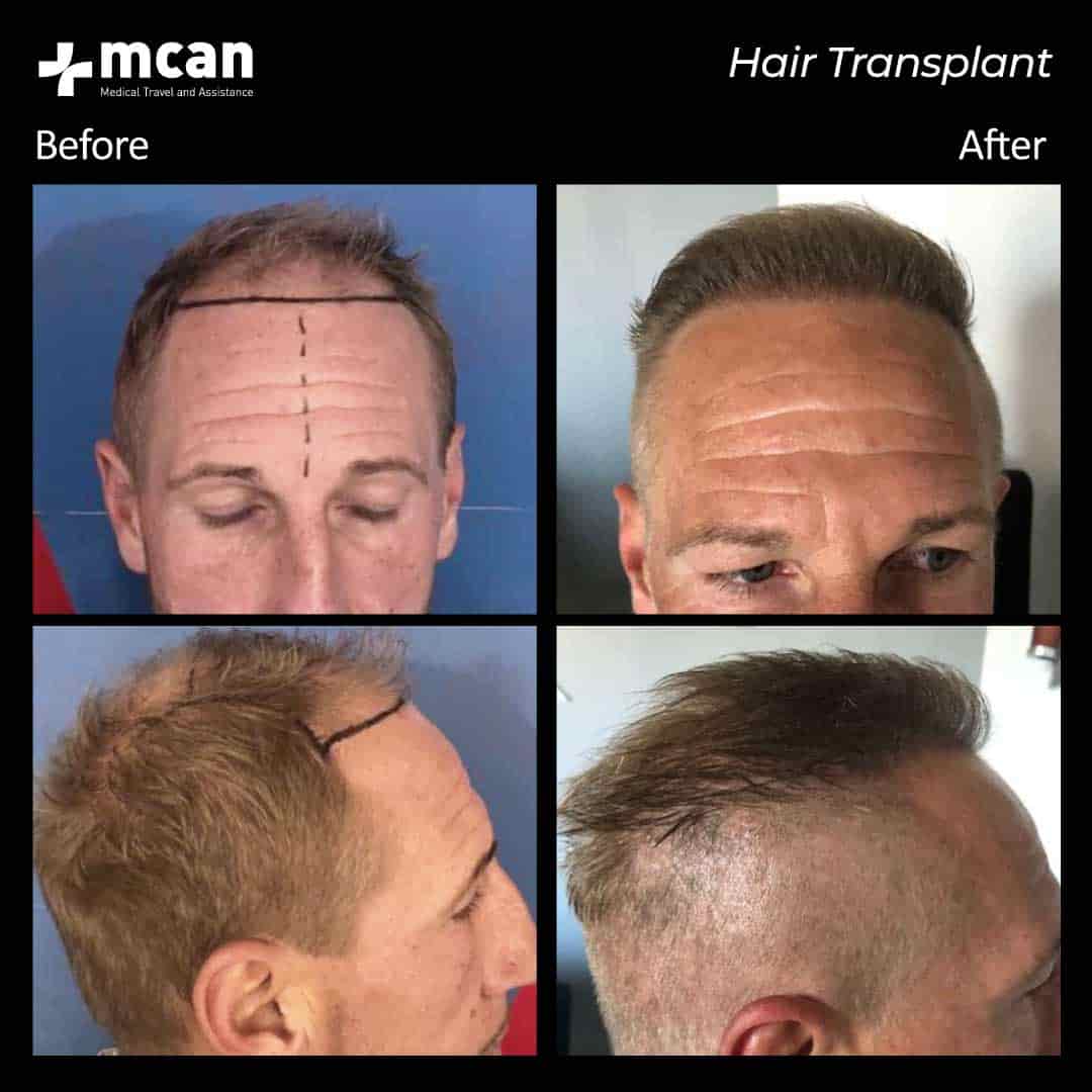 hair transplantation 94