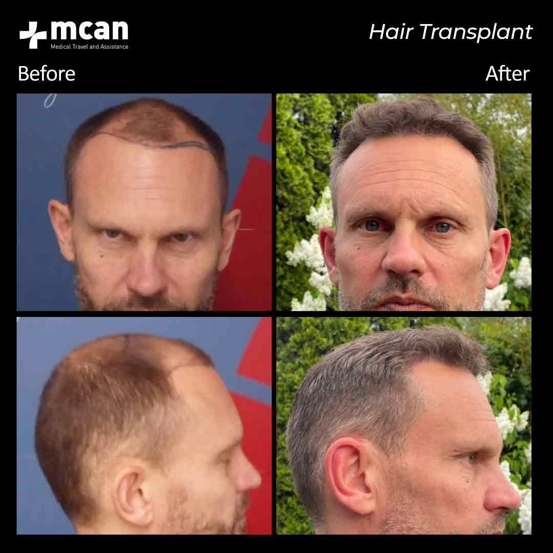 hair transplantation 96