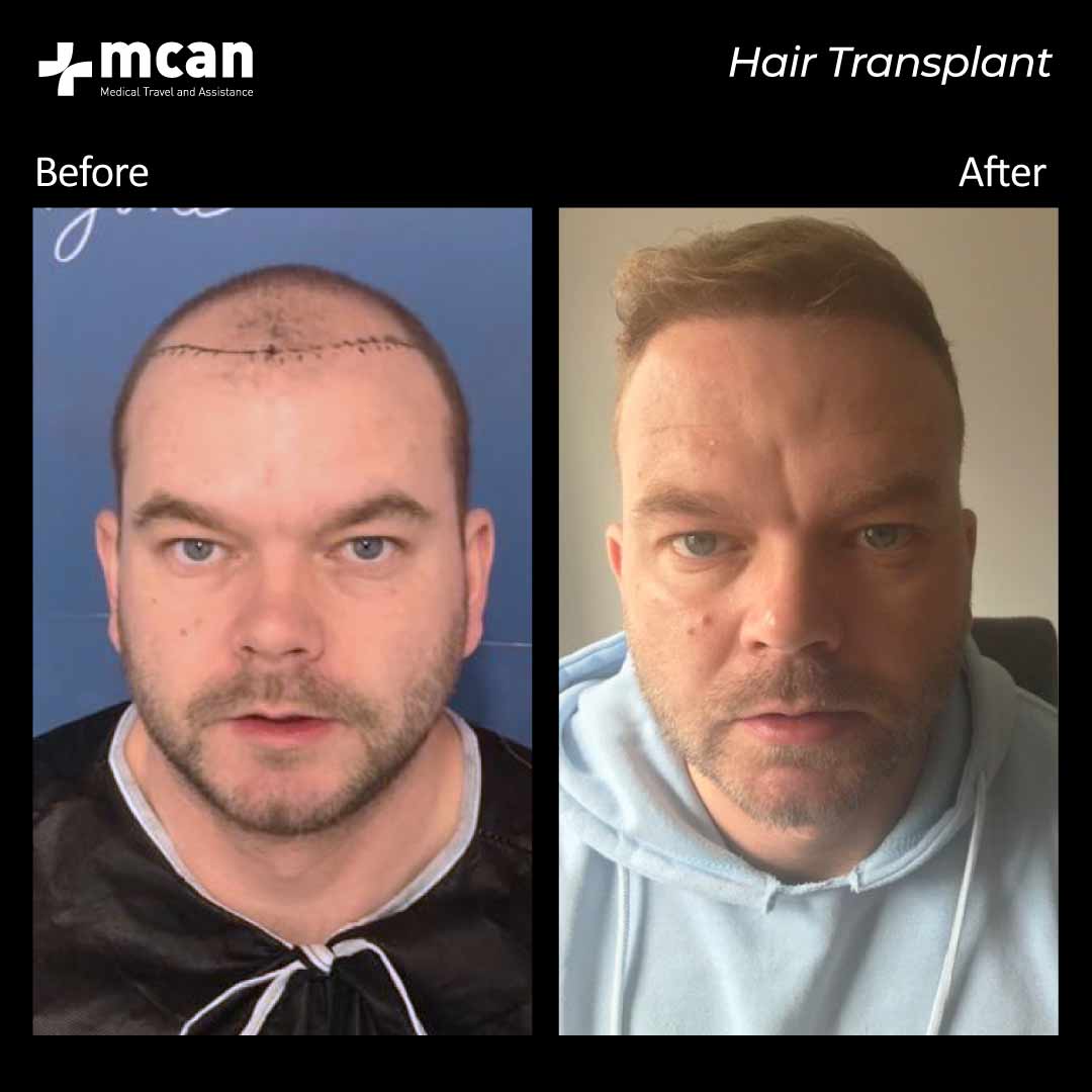 hair transplantation 97
