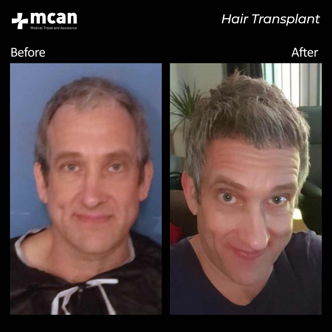hair transplantation 98
