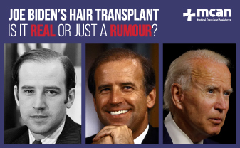 Everything About Joe Biden Hair Transplant